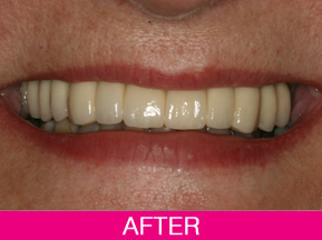 dental implants after