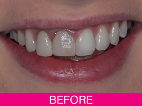 straight teeth before treatment