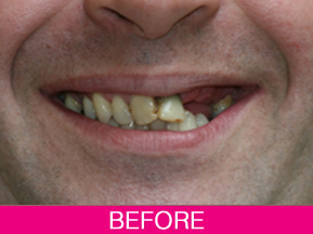 dental implants before