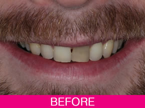 tooth whitening before